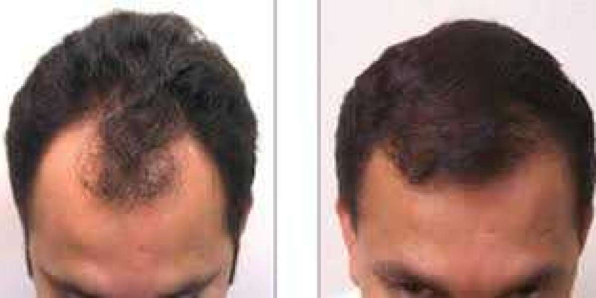 Hair Transplant Growth Stages