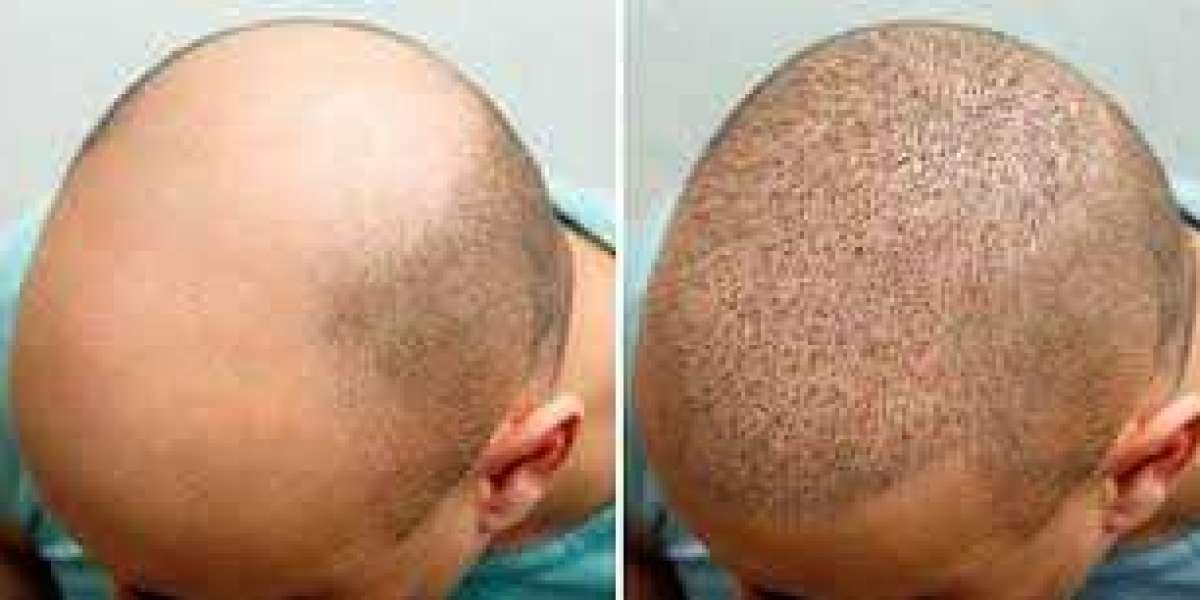 Two Weeks After FUE Hair Transplant