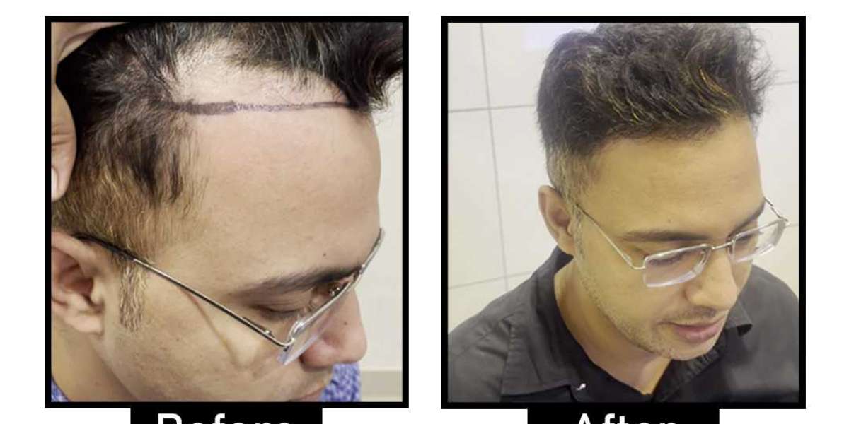 Best Hair Transplant Techniques in Delhi for Permanent Results from AWISH Clinic