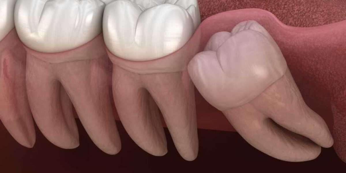 wisdom tooth extraction singapore