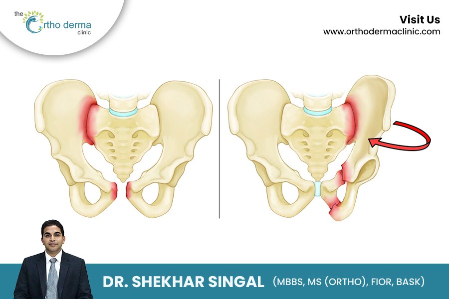 Understanding Pelvic Fracture: Diagnosis, Treatment & Recovery