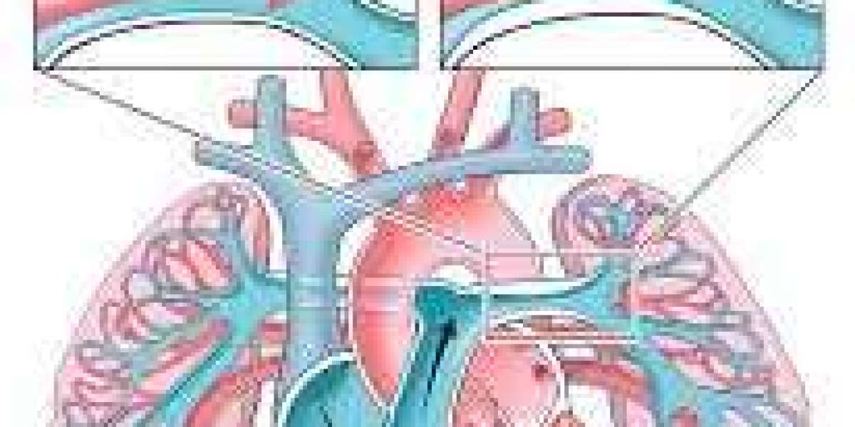 Breaking Down Pulmonary Hypertension